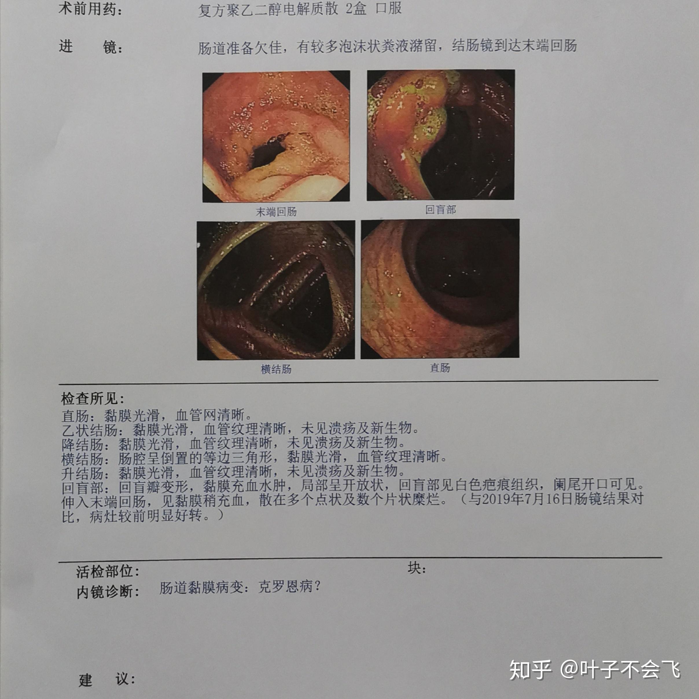 克罗恩病组织病理_克罗恩病病理诊断要点_克罗恩病的病理特点有