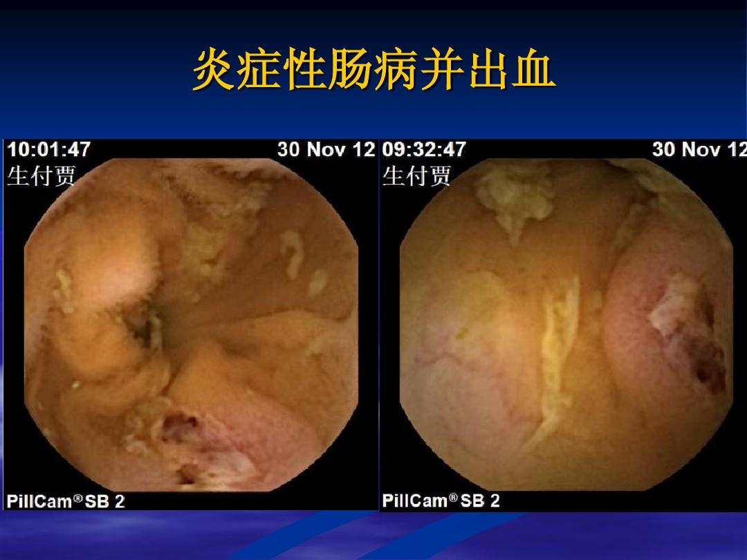 克罗恩病组织病理_克罗恩病病理诊断要点_克罗恩病的病理特点有