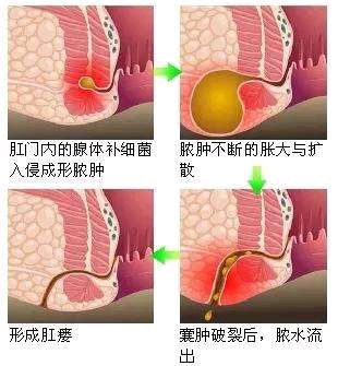 肛门失禁提肛管用吗_肛门失禁_肛门失禁的原因