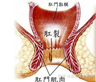 肛门失禁提肛管用吗_肛门失禁_肛门失禁的原因