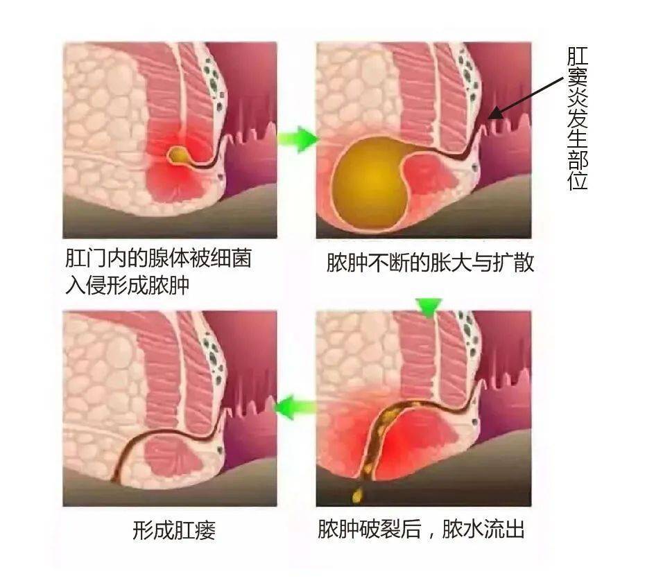 肛门失禁提肛管用吗_肛门失禁的原因_肛门失禁