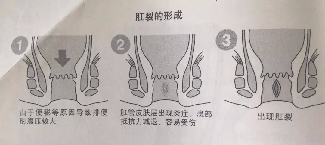 肛门失禁提肛管用吗_肛门失禁_肛门失禁的原因