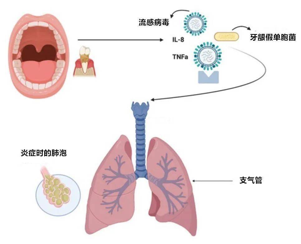 白痰肺炎_肺感染白痰_肺部感染白痰