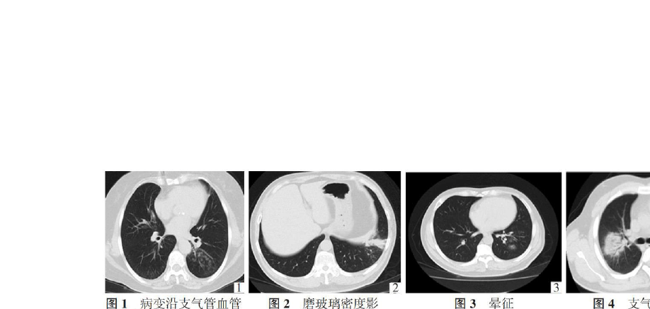 肺炎克雷白杆菌_肺炎克雷白杆菌的典型临床表现_肺炎克雷杆菌白细胞低