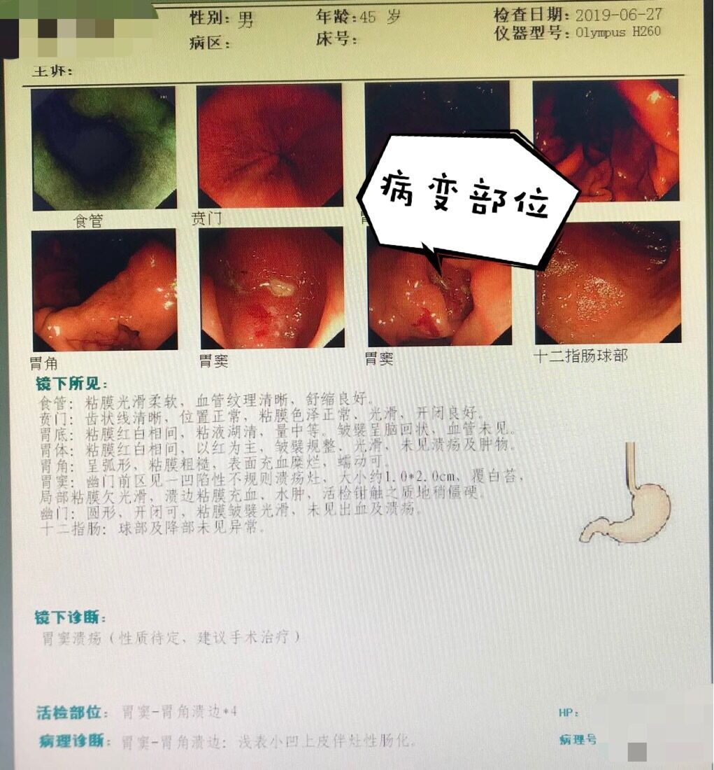 中里巴人调理胃_中里巴人治疗胃不舒服_中里巴人论坛胃病