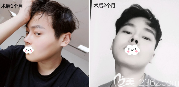 肛瘘是克罗恩的概率_克罗恩病肛瘘与普通肛瘘的区别_肛瘘一定是克罗恩吗