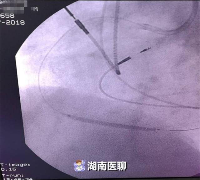 心梗介入治疗并发症_心肌梗死介入后的并发症_心肌梗塞介入手术并发症