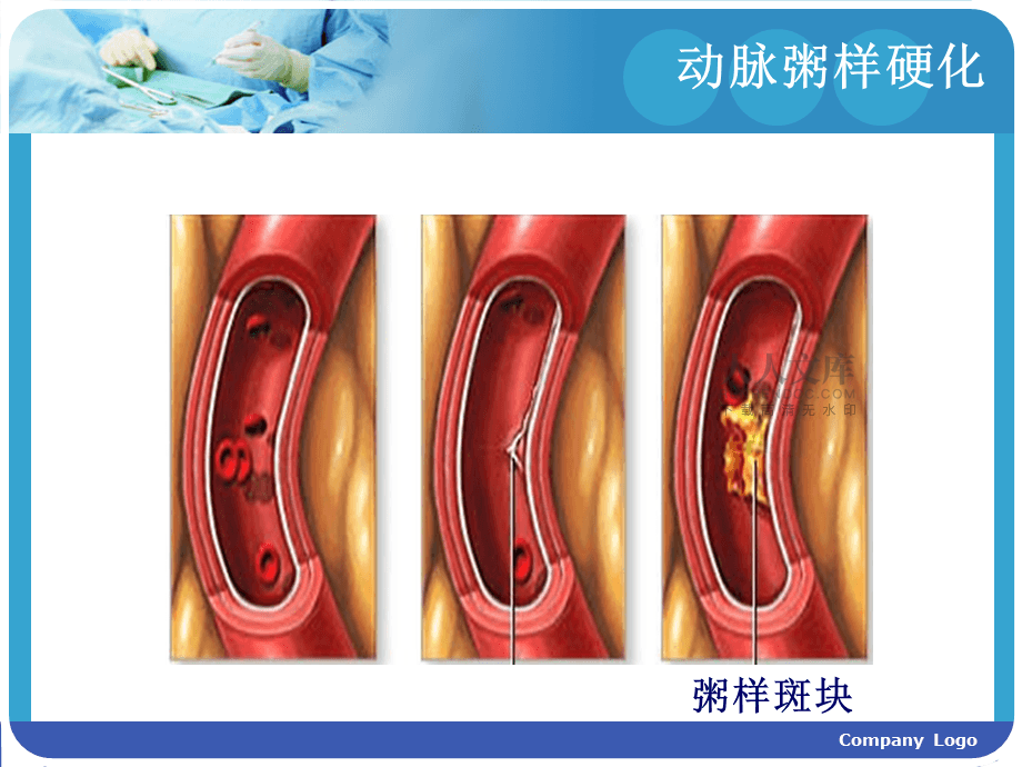 冠心病护理课件_冠心病护理ppt课件免费_冠心病护理讲课视频