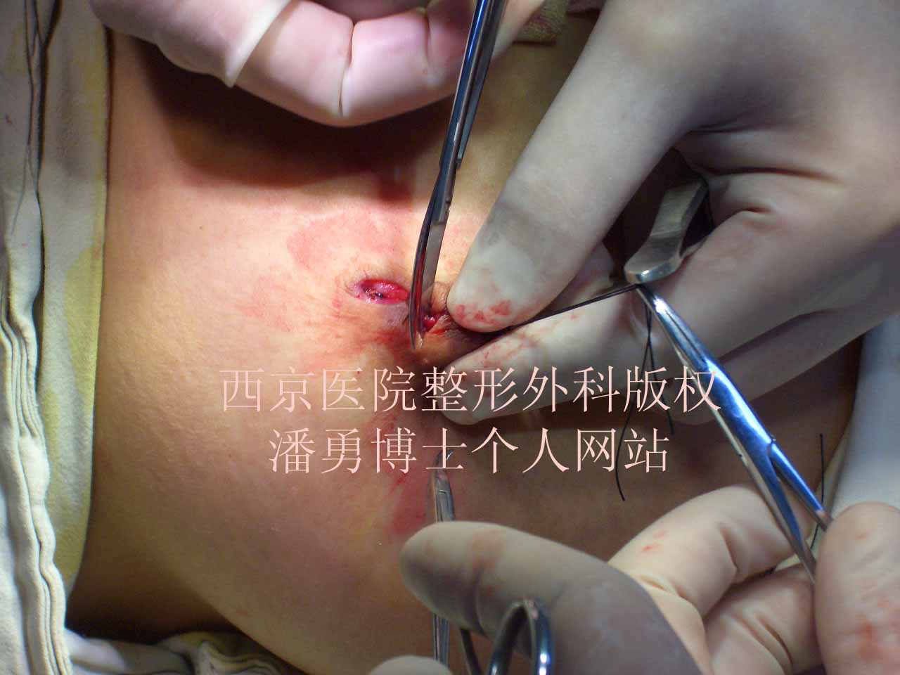 进展性卒中治疗_进展性卒中怎么治_进展治性卒中的原因