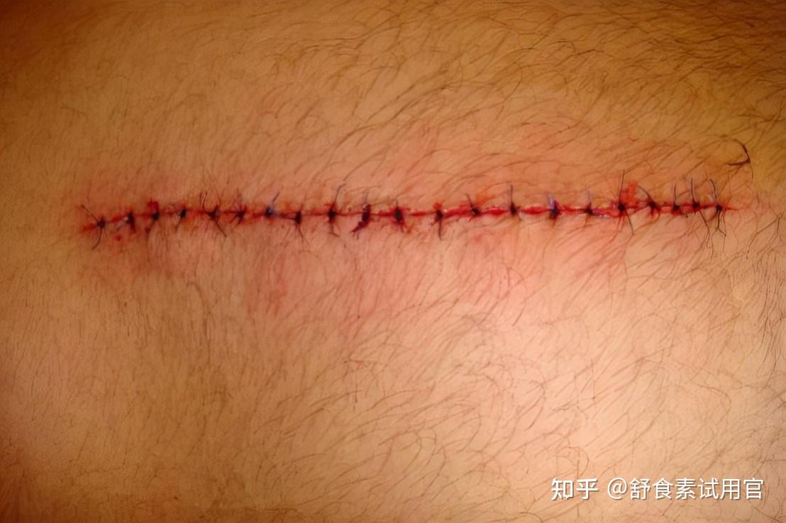 多长手术能好肛瘘时间后不复发_肛瘘手术后多长时间能好啊_肛瘘手术多长时间能做完
