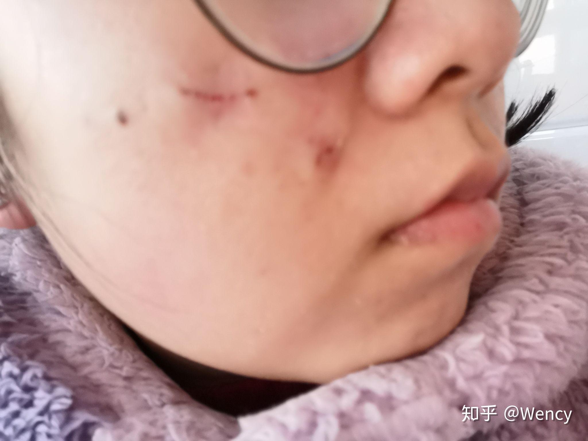 多长手术能好肛瘘时间后不复发_肛瘘手术多长时间能做完_肛瘘手术后多长时间能好啊