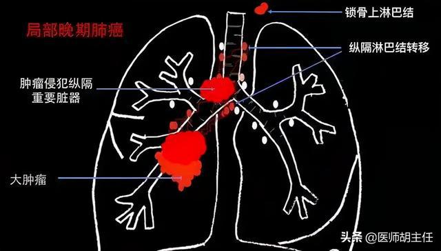 turcot综合征_综合征收什么意思_综合征收制