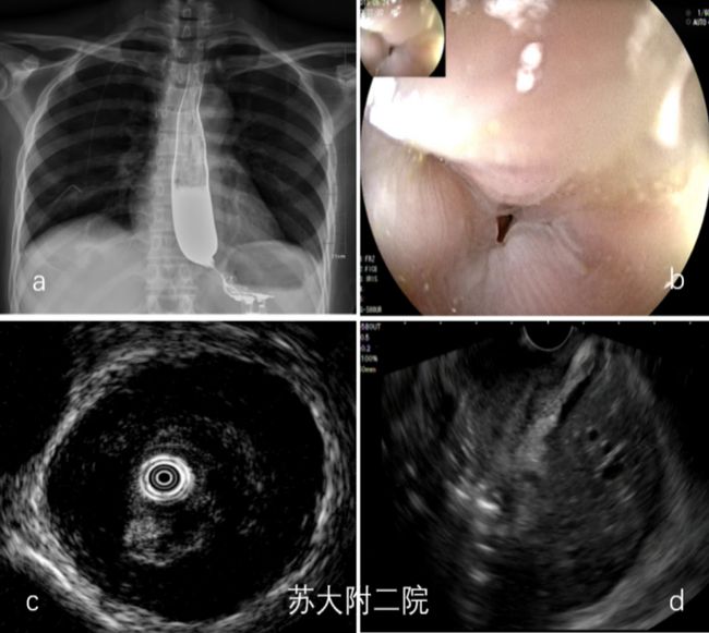 turcot综合征_综合征收制_综合征收什么意思