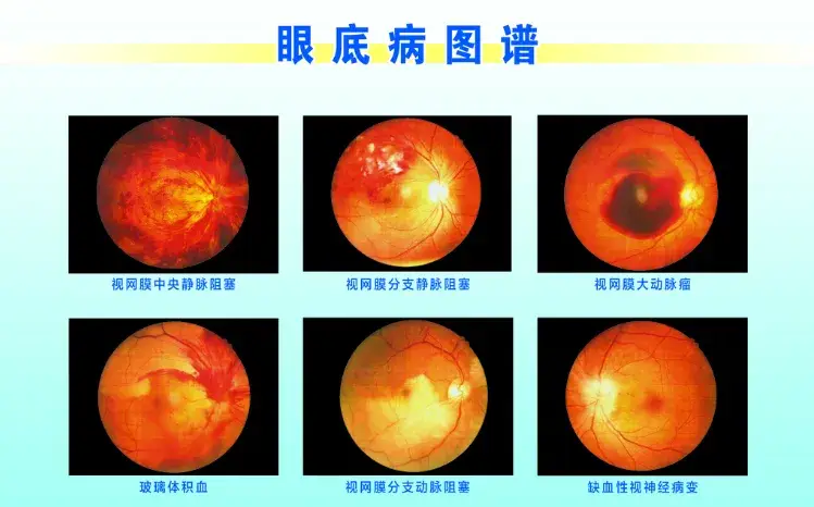 罗恩克病_罗克恩病怎么确诊_如何确诊克罗恩