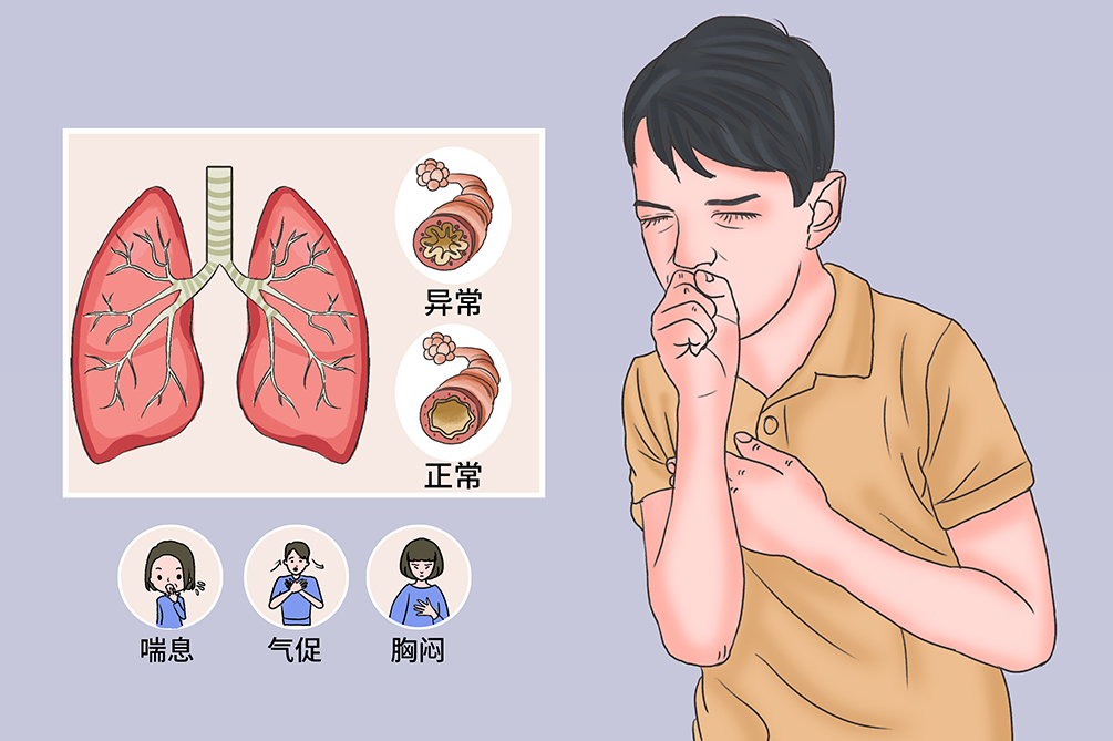 有哮喘的运动员_哮喘通过运动可以改善吗_哮喘运动后会加重吗