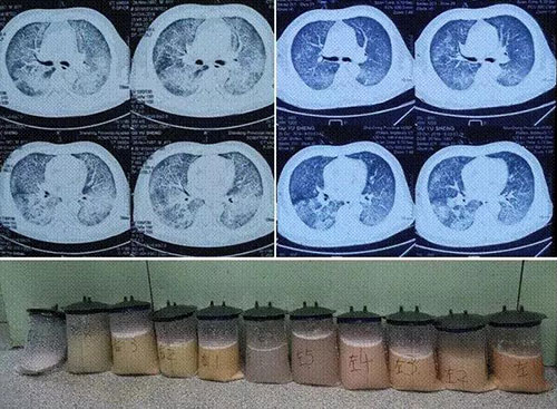 肺泡蛋白质沉积症会传染吗_肺泡蛋白沉积_肺泡蛋白质沉积症发病率