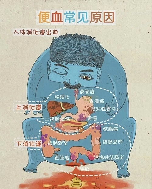 出血大便疼回事是痔疮吗_大便出血是怎么回事 不疼_出血大便疼回事是什么原因