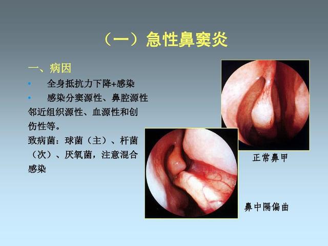 肺炎 c反应蛋白_肺炎蛋白_肺炎c蛋白反应会高吗