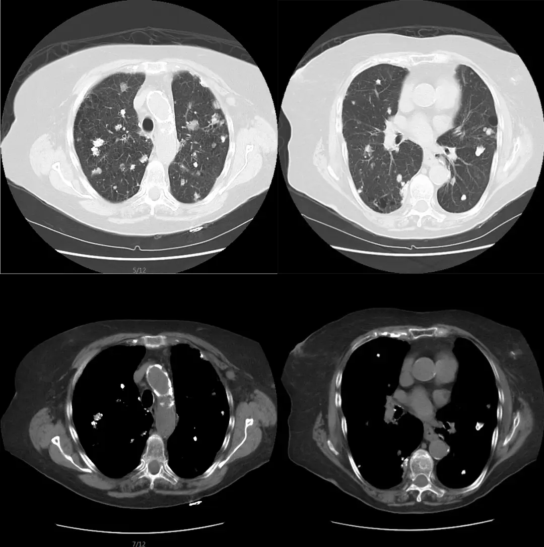 三型肺结核症状有哪些_肺症状结核型有哪些_肺结核类型及症状