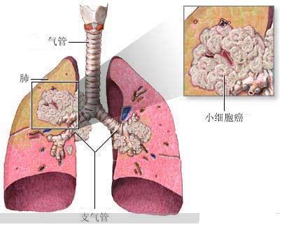 肺癌白蛋白高是怎么回事_白蛋白肺癌_肺癌+白蛋白