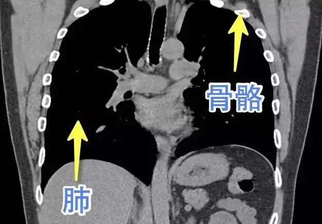 肺ct 白-深度探析肺部CT白影：形态特征与临床意义