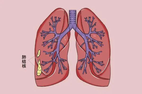 肺可怕结核有什么症状_肺结核到底有多可怕_肺可怕结核有传染性吗