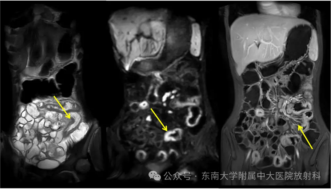 克罗恩病x线表现_克罗恩病理诊断_课罗恩病