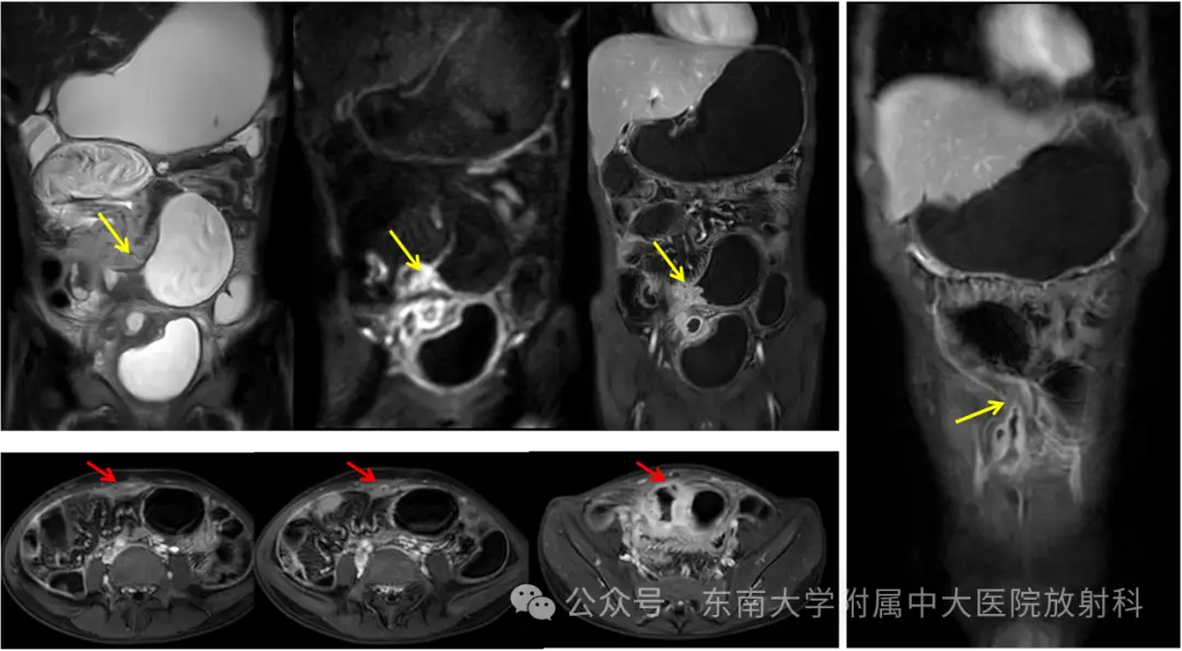 课罗恩病_克罗恩病理诊断_克罗恩病x线表现