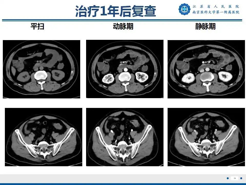 克罗恩病x线表现_克罗恩病理诊断_课罗恩病