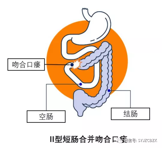 克罗恩护理常规ppt_克罗恩病护理问题_克罗恩病护理要点