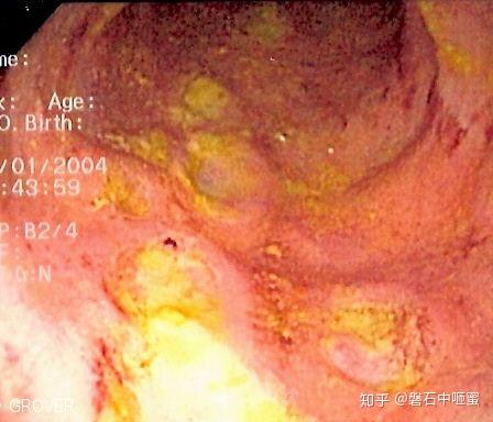 克罗恩病护理问题_克罗恩护理常规ppt_克罗恩病护理要点