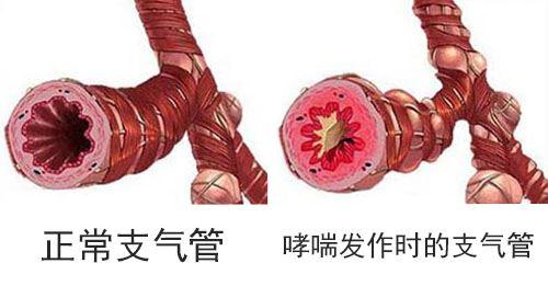 死于名人哮喘的有哪些_哪些名人有哮喘病_死于哮喘的名人