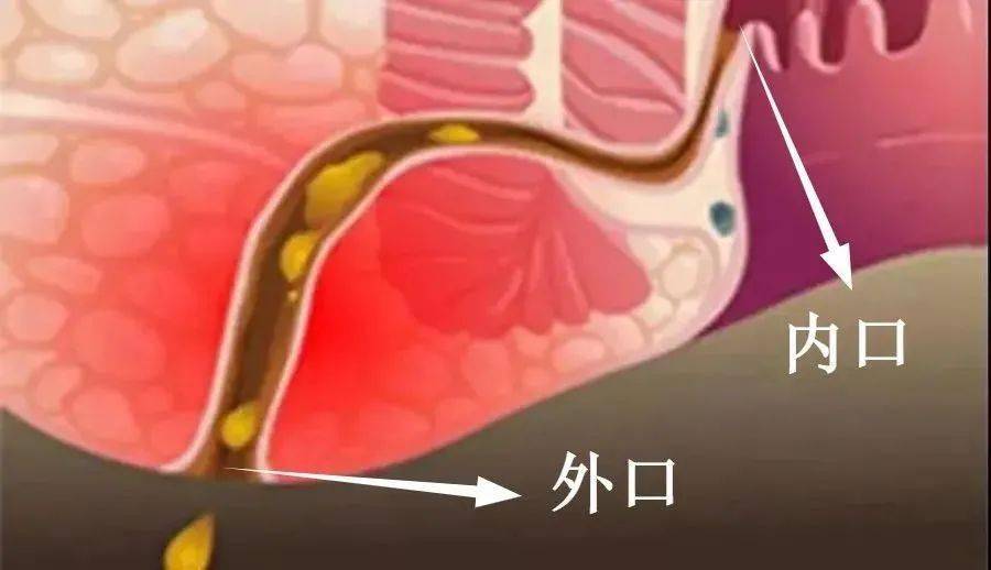 肛瘘手术时间长吗_肛瘘手术多久和正常人一样_肛瘘手术多长时间长好