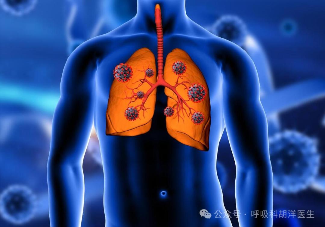造成呼吸衰竭的病原体_出现呼吸衰竭的原因是_呼吸衰竭定义及可能原因