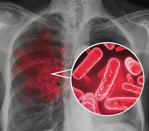 肺炎肺结核最大区别表现_肺炎加肺结核要治疗多久_肺炎和肺结核哪个严重