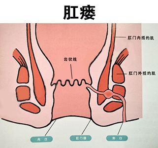 肛瘘二次手术间隔时间_间隔手术次肛瘘时间多长_两次肛瘘手术间隔时间