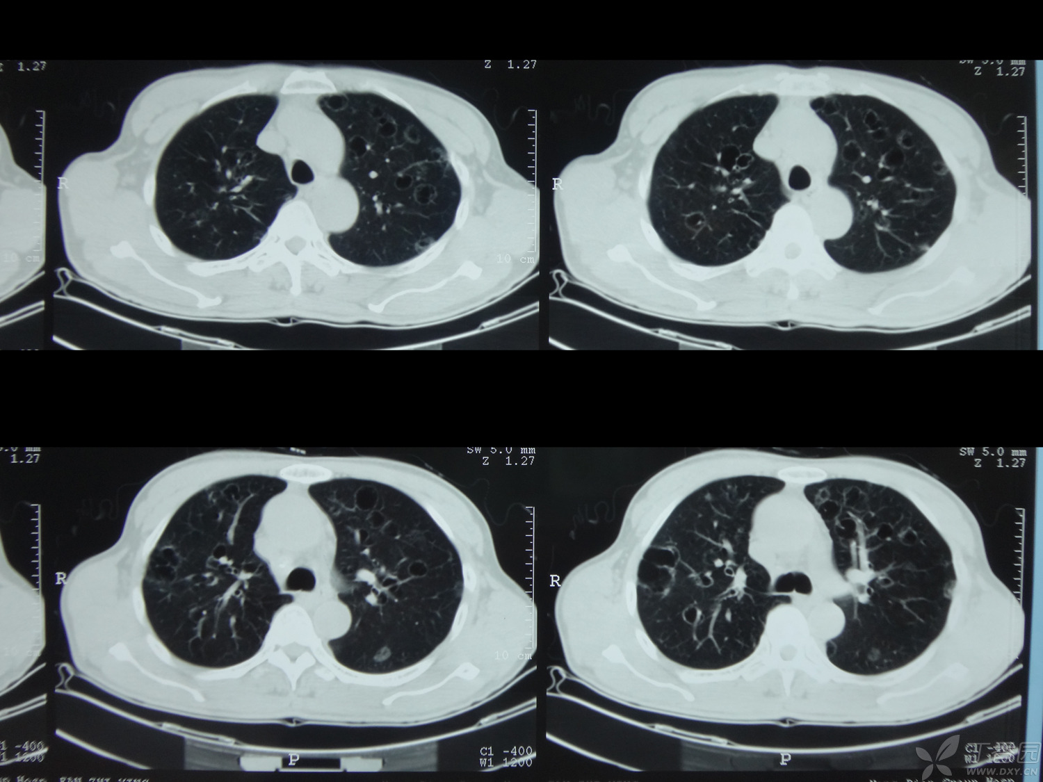 肺空洞是怎么形成的-了解肺空洞：小心身体里的秘密空洞威胁呼吸