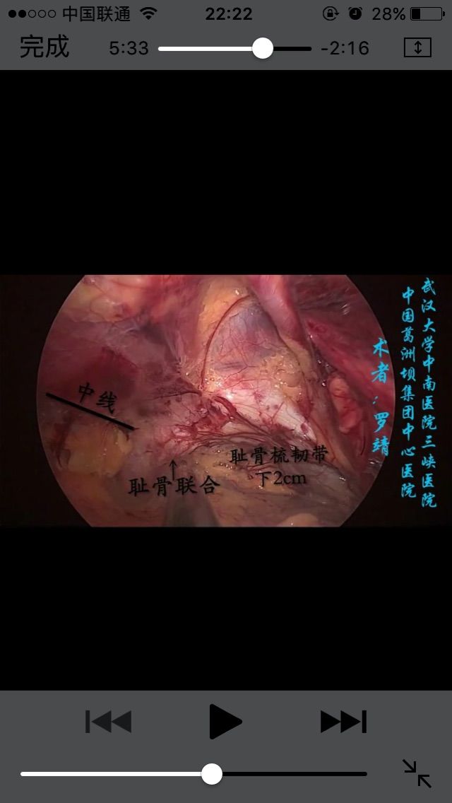 股疝手术步骤_股疝手术指征_股疝手术视频大全视频