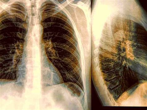 得个肺结核会引起肺癌吗_肺结核会更容易感染新型肺炎吗_怎样会患上三型肺结核