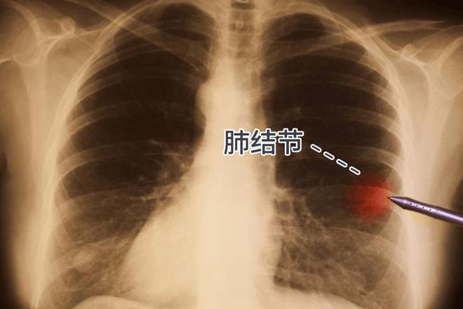 怎样会患上三型肺结核_得个肺结核会引起肺癌吗_肺结核会更容易感染新型肺炎吗