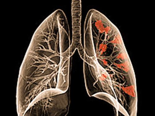 得个肺结核会引起肺癌吗_肺结核会更容易感染新型肺炎吗_怎样会患上三型肺结核