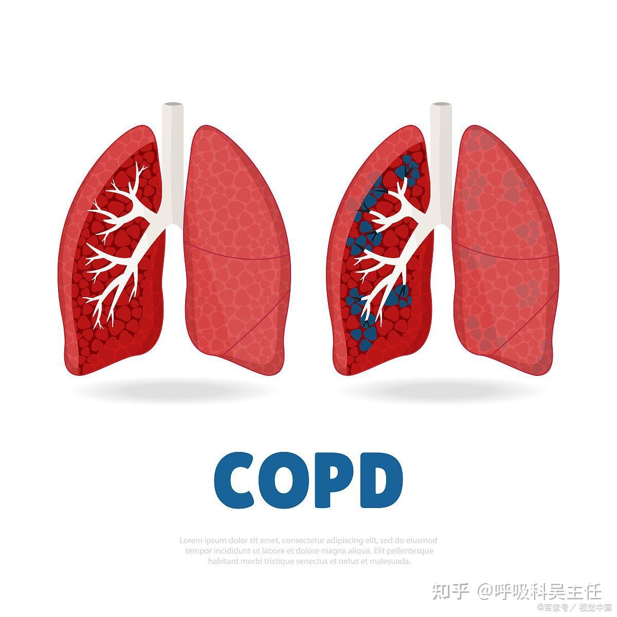 Ⅰ型呼吸衰竭定义_呼吸衰竭如何定义和分类_呼吸衰竭的定义和分型是什么