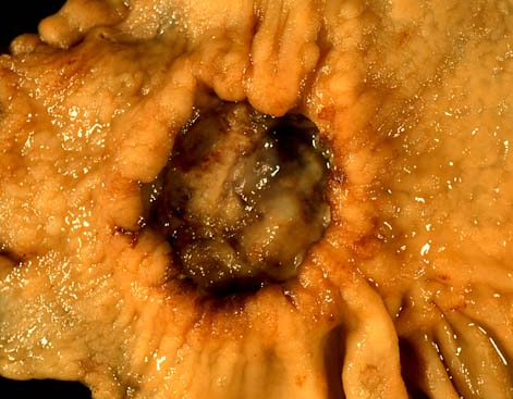 胃癌ct图片大全-冰冷仪器背后的生命故事：胃癌 CT 图片揭示的脆弱与残酷