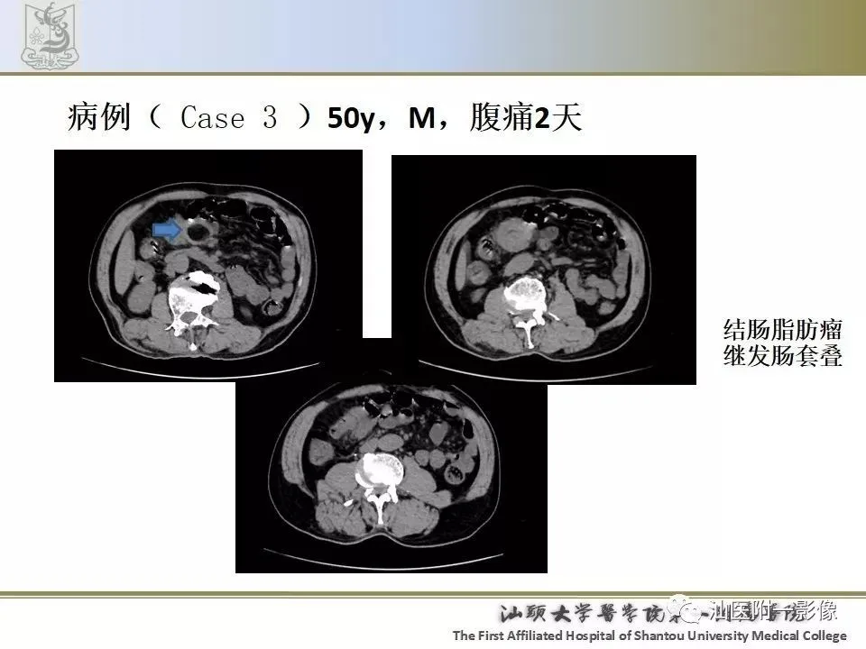 肠套叠ct表现_肠套叠ct描述模板_肠套叠的ct三大典型症状