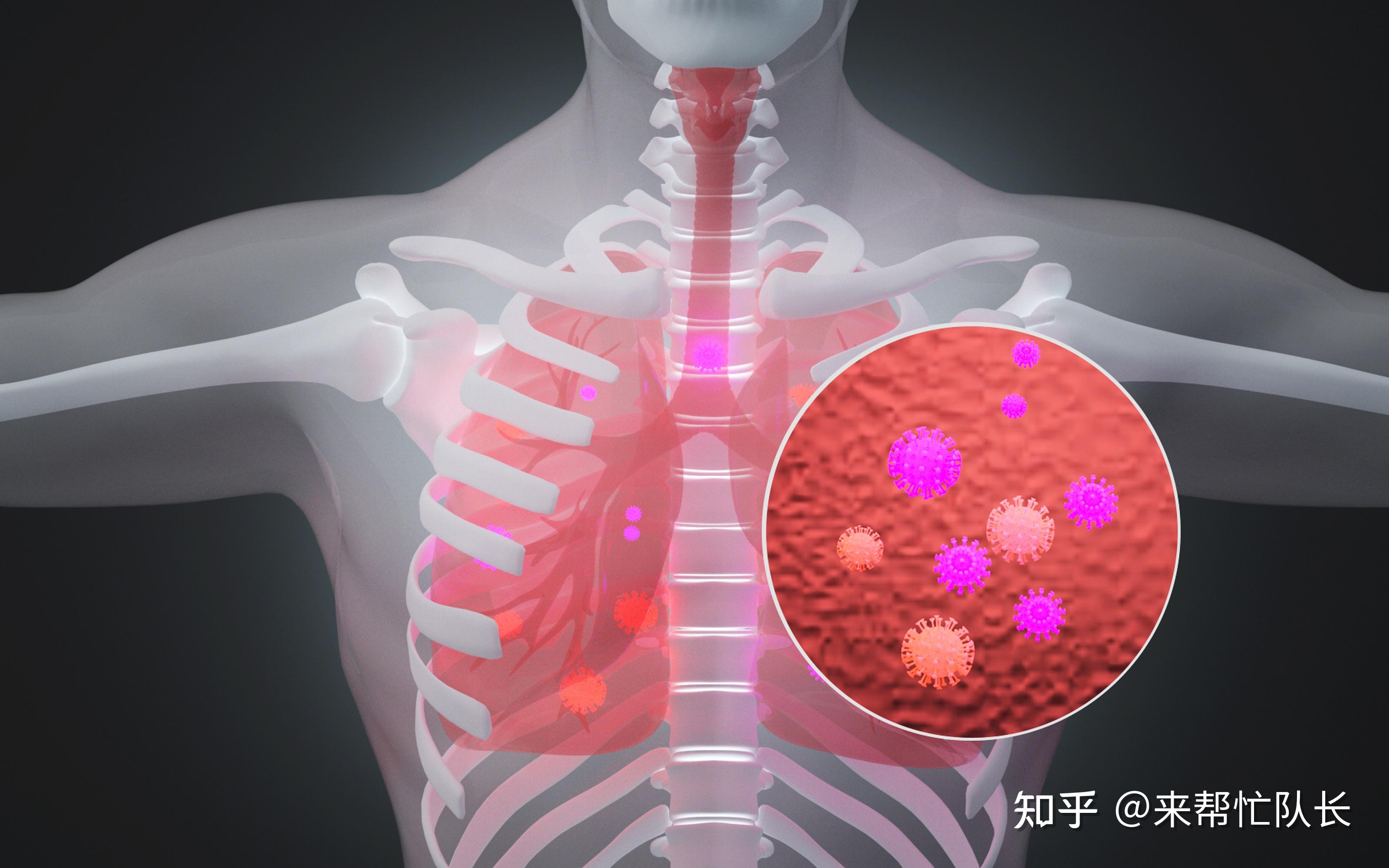 感染肺结核早期症状_肺早期感染症状结核能治好吗_肺早期感染症状结核怎么治疗