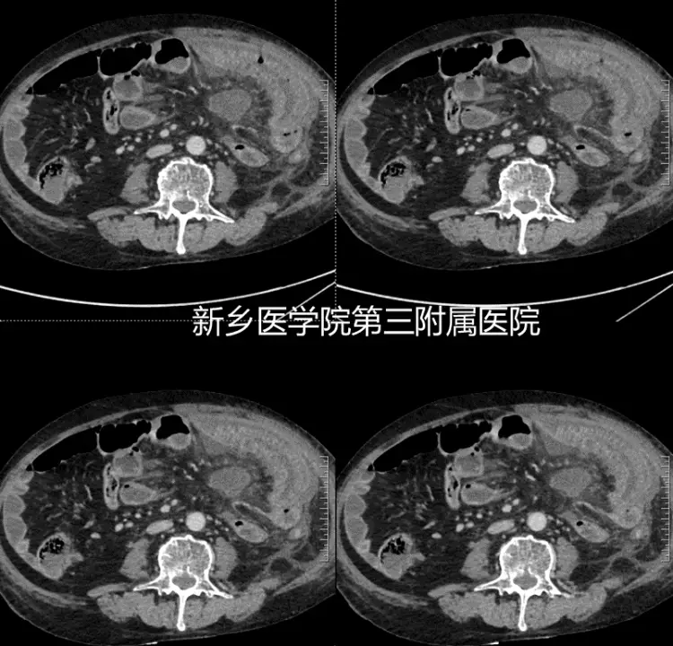 克罗恩病ct表现_罗克恩病严重吗_罗克罗恩病