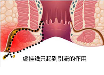 肛瘘手术恢复时间_肛瘘手术恢复好了啥样子_手术恢复肛瘘时间多长