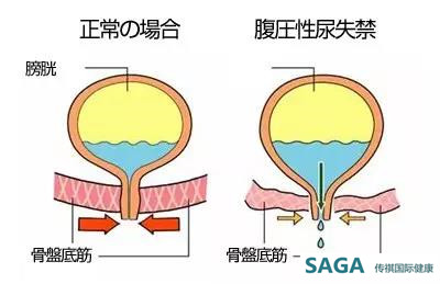 治疗肛门失禁最好药_国内治疗肛门失禁的医院_肛门失禁能治疗吗