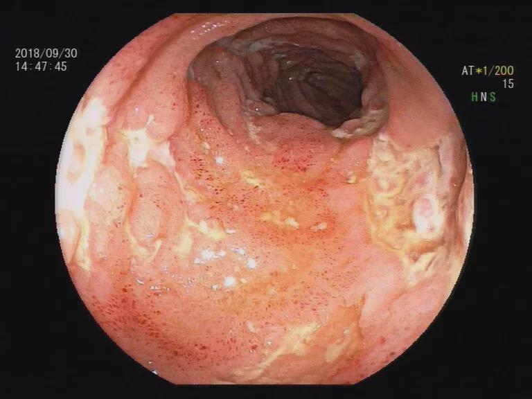 克罗恩病肠镜图片_罗恩病的症状_罗恩病是什么