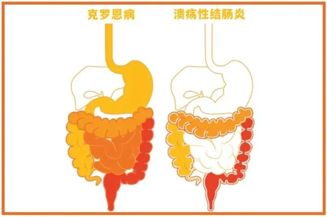 克罗恩关节炎_克罗恩病关节炎_克罗恩关节炎症指什么